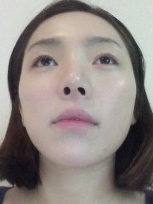 長(zhǎng)春中妍整形醫(yī)院吳學(xué)軍醫(yī)生做玻尿酸墊下巴+玻尿酸豐太陽(yáng)穴案例效果對(duì)比圖