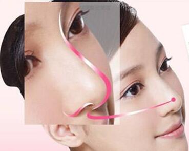 南京星美美容鼻翼縮小