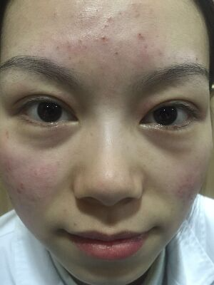 西安壹加壹整形醫(yī)院劉晨醫(yī)生做點陣激光祛痘效果怎么樣？附點陣激光祛痘效果圖