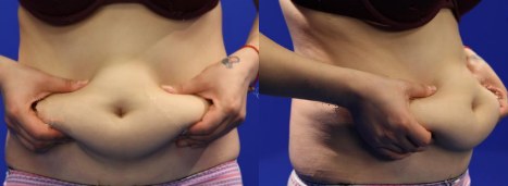 廣州韓佳人整形醫(yī)院詹曉芳做腹部吸脂效果怎么樣？附案例效果對比圖