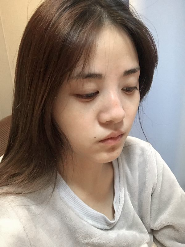 駐馬店締萊美醫(yī)療整形醫(yī)生李冰做鼻綜合整形怎么樣？附鼻綜合整形案例效果對(duì)比圖