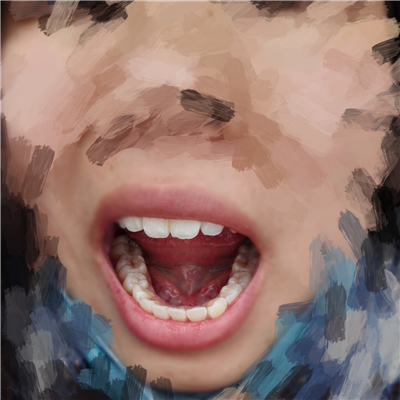 重慶華西牙科醫(yī)院童冠雄超聲波洗牙怎么樣？附超聲波洗牙案例對(duì)比圖