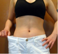 廣州韓佳人整形醫(yī)院詹曉芳做腹部吸脂效果怎么樣？附案例效果對比圖