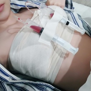 廣州廣大整形美容醫(yī)院醫(yī)生查旭山做假體隆胸怎么樣？附案例