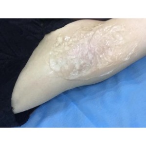 廈門張銘整醫(yī)療整形醫(yī)生張小玲做激光脫腋毛怎么樣？附激光脫腋毛效果對比圖