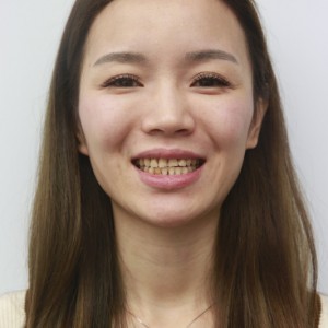 安慶渡江口腔醫(yī)院張良斌醫(yī)生牙齒貼面怎么樣？附牙齒貼面效果圖