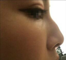 天津時(shí)光整形醫(yī)生盧丙侖做駝峰鼻怎么樣？附案例效果對(duì)比圖