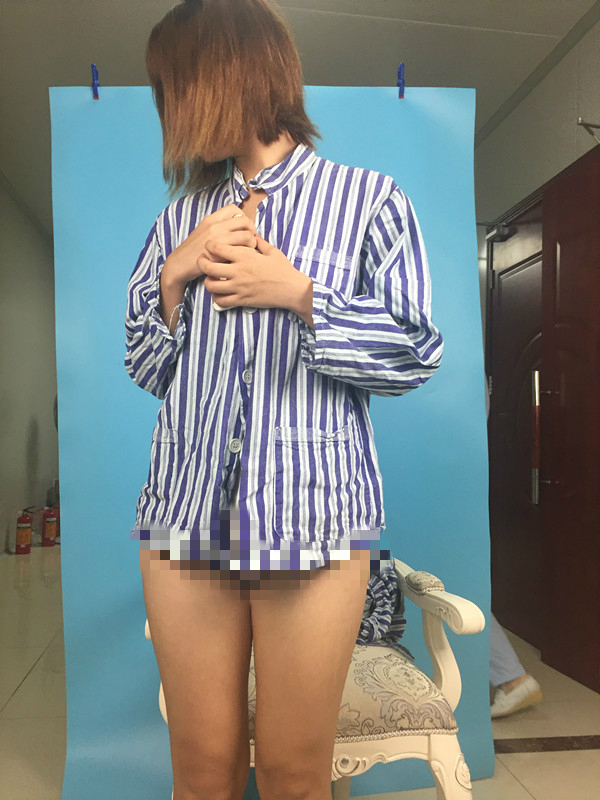 北京蒂凡妮整形靳玉彪醫(yī)生做大腿吸脂怎么樣？附大腿吸脂案例效果對比圖