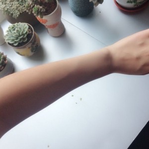 鄭州屈小麗醫(yī)療整形醫(yī)院醫(yī)生劉丹做手臂脫毛怎么樣？附手臂脫毛案例