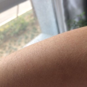 鄭州屈小麗醫(yī)療整形醫(yī)院醫(yī)生劉丹做手臂脫毛怎么樣？附手臂脫毛案例