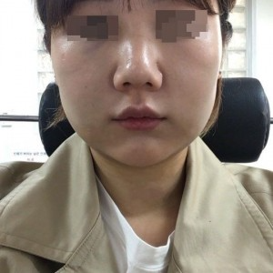 太原麗都整形醫(yī)院劉晉艷醫(yī)生做光纖溶脂瘦臉怎么樣？附案例效果對比圖