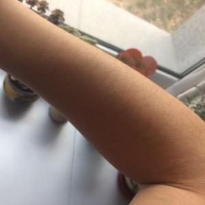 鄭州屈小麗醫(yī)療整形醫(yī)院醫(yī)生劉丹做手臂脫毛怎么樣？附手臂脫毛案例