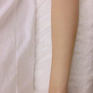 鄭州屈小麗醫(yī)療整形醫(yī)院醫(yī)生劉丹做手臂脫毛怎么樣？附手臂脫毛案例