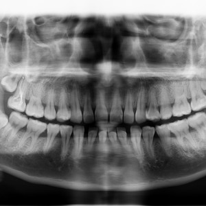 廈門拜博口腔醫(yī)院醫(yī)生張忠做牙齒隱形矯正怎么樣？附案例效果對比圖