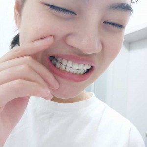 廈門拜博口腔醫(yī)院醫(yī)生張忠做牙齒隱形矯正怎么樣？附案例效果對比圖