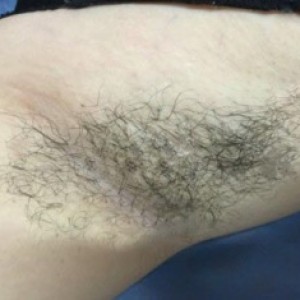 廈門張銘整醫(yī)療整形醫(yī)生張小玲做激光脫腋毛怎么樣？附激光脫腋毛效果對比圖