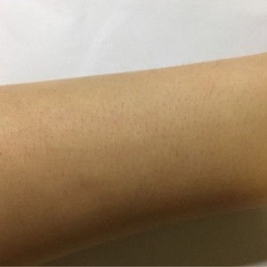 鄭州屈小麗醫(yī)療整形醫(yī)院醫(yī)生劉丹做手臂脫毛怎么樣？附手臂脫毛案例