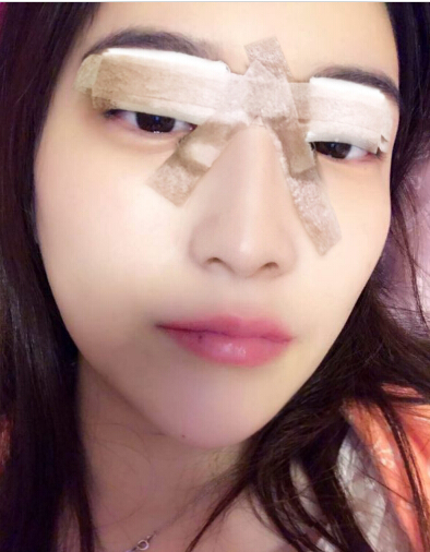 張家港唯恩整形醫(yī)院陳天杰醫(yī)生切開雙眼皮案例效果對(duì)比圖