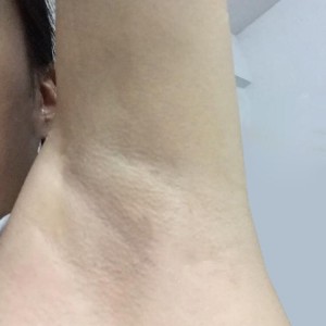 廈門張銘整醫(yī)療整形醫(yī)生張小玲做激光脫腋毛怎么樣？附激光脫腋毛效果對比圖