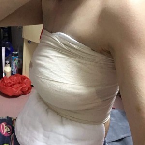 佛山東方女子醫(yī)院整形美容中心姜政輝做自體脂肪隆胸案例效果對比圖