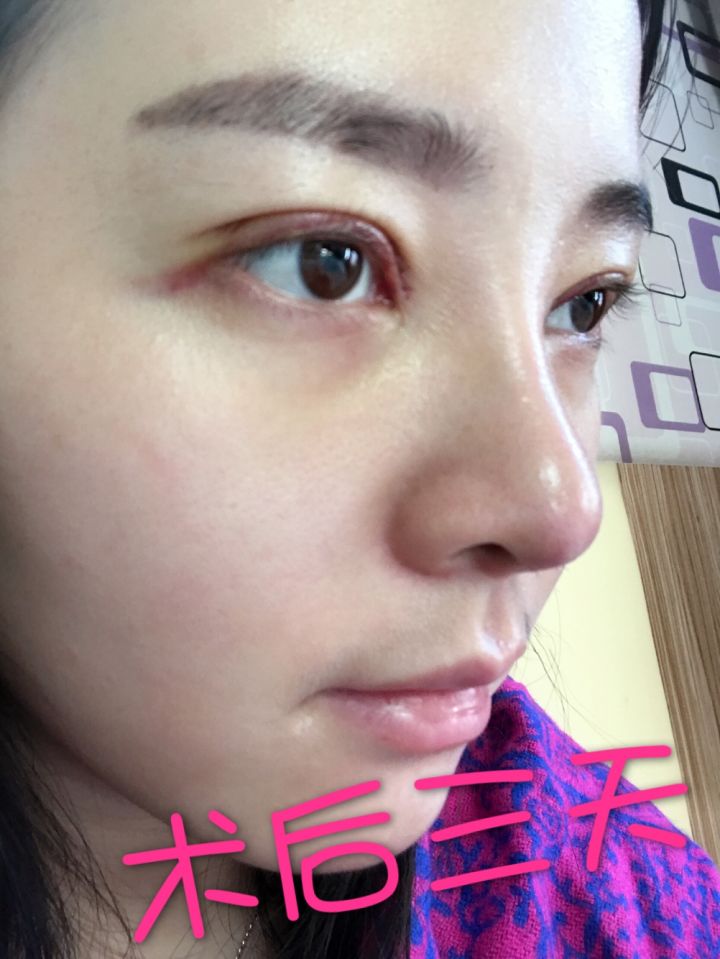 北京京韓整形醫(yī)生王義山做埋線雙眼皮怎么樣？附案例效果對(duì)比圖