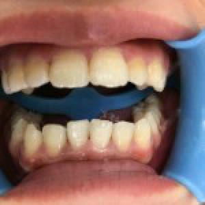 洛陽友好口腔醫(yī)院醫(yī)生楊愛芳做牙齒冷光美白怎么樣？附案例效果圖