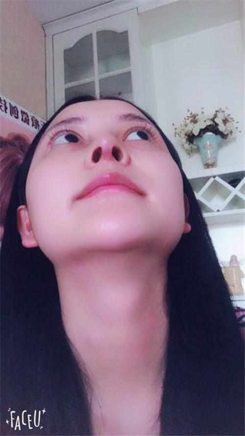 鄭州華領(lǐng)醫(yī)療美容醫(yī)院醫(yī)生張永濤做硅膠假體隆鼻怎么樣？附案例效果對(duì)比圖