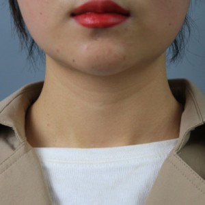 上海名媛醫(yī)療整形醫(yī)生閆嬌君做嗨體去頸紋效果怎么樣？附案例效果圖