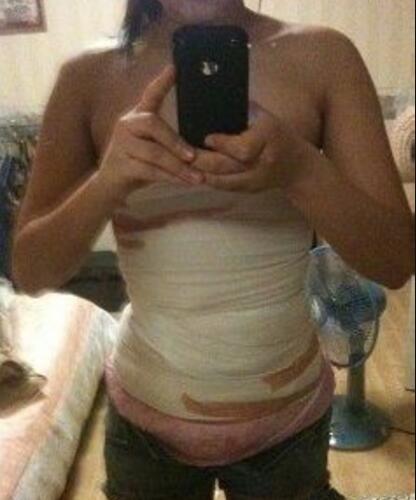 安徽韓美整形醫(yī)院醫(yī)生金壽信做水動(dòng)力吸脂怎么樣？附案例效果對(duì)比圖