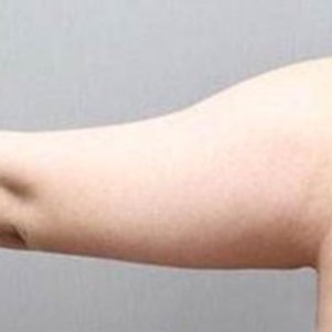 岳陽愛思特醫(yī)療美容醫(yī)院醫(yī)生王福生做手臂吸脂怎么樣？附案例效果圖