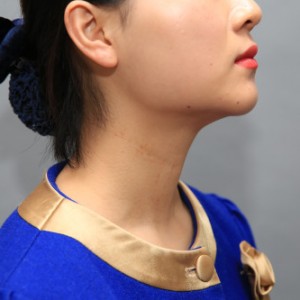 上海名媛醫(yī)療整形醫(yī)生閆嬌君做嗨體去頸紋效果怎么樣？附案例效果圖