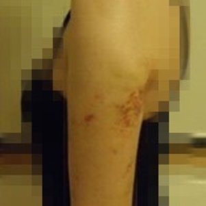 岳陽愛思特醫(yī)療美容醫(yī)院醫(yī)生王福生做手臂吸脂怎么樣？附案例效果圖