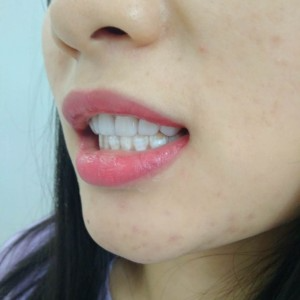 洛陽友好口腔醫(yī)院醫(yī)生李新然做牙貼面怎么樣？附案例效果圖