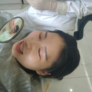 洛陽友好口腔醫(yī)院醫(yī)生李新然做牙貼面怎么樣？附案例效果圖