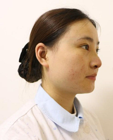 1528339523944399.jpg 深圳陽(yáng)光整形美容醫(yī)院醫(yī)生張平做膨體隆鼻+雙眼皮+注射瘦臉案例效果對(duì)比圖