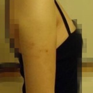 岳陽愛思特醫(yī)療美容醫(yī)院醫(yī)生王福生做手臂吸脂怎么樣？附案例效果圖