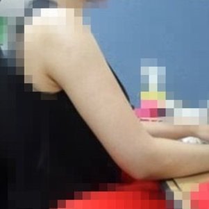 岳陽愛思特醫(yī)療美容醫(yī)院醫(yī)生王福生做手臂吸脂怎么樣？附案例效果圖