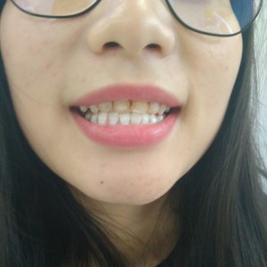 洛陽友好口腔醫(yī)院醫(yī)生李新然做牙貼面怎么樣？附案例效果圖