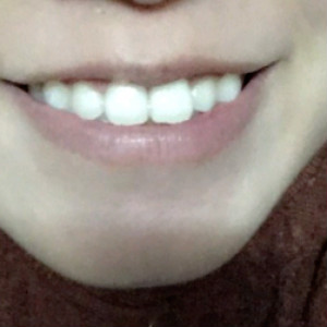 洛陽友好口腔醫(yī)院醫(yī)生楊愛芳做牙齒冷光美白怎么樣？附案例效果圖