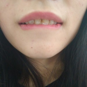 黔西南興義京州口腔醫(yī)院醫(yī)生徐勇做牙貼面怎么樣？附案例效果對(duì)比圖