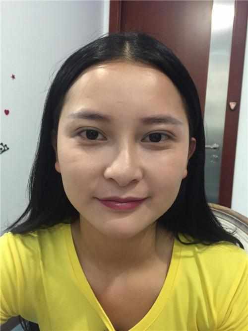 鄭州華領(lǐng)醫(yī)療美容醫(yī)院醫(yī)生張永濤做硅膠假體隆鼻怎么樣？附案例效果對(duì)比圖