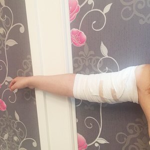 岳陽愛思特醫(yī)療美容醫(yī)院醫(yī)生王福生做手臂吸脂怎么樣？附案例效果圖