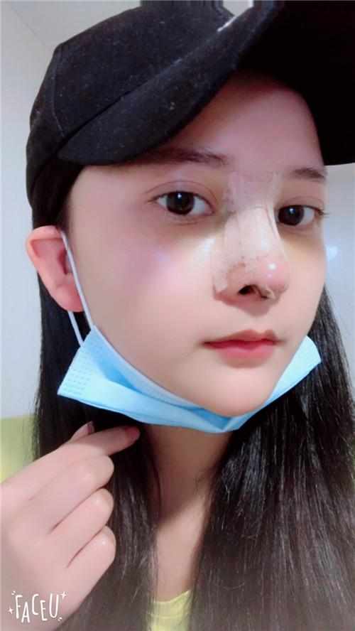 鄭州華領(lǐng)醫(yī)療美容醫(yī)院醫(yī)生張永濤做硅膠假體隆鼻怎么樣？附案例效果對(duì)比圖