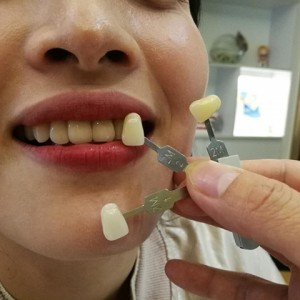 上海科瓦口腔醫(yī)院醫(yī)生鄧建儒做牙齒冷光美白怎么樣？附案例效果對比圖