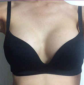 昆山百達(dá)麗醫(yī)療美容門診部醫(yī)生周嬡做自體脂肪隆胸怎么樣？附案例效果對比圖