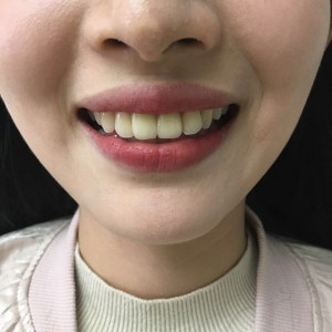 上?？仆呖谇会t(yī)院醫(yī)生鄧建儒做牙齒冷光美白怎么樣？附案例效果對比圖