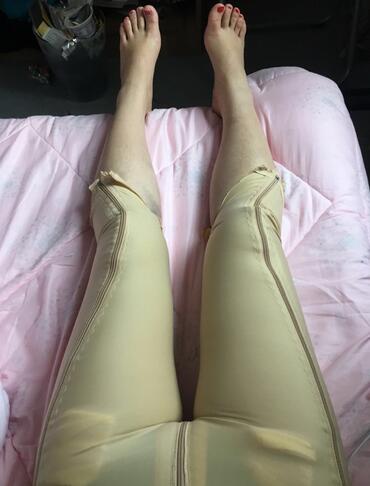 上海保加醫(yī)療美容門診部做大腿吸脂怎么樣？附楊勇醫(yī)生案例效果對比圖