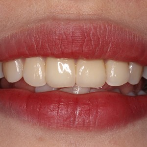 上海科瓦口腔醫(yī)院醫(yī)生鄧建儒做牙齒冷光美白怎么樣？附案例效果對比圖