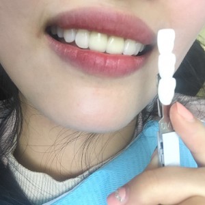 上?？仆呖谇会t(yī)院醫(yī)生鄧建儒做牙齒冷光美白怎么樣？附案例效果對比圖