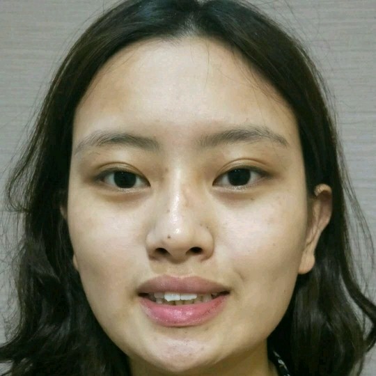 廣州愛來(lái)整形醫(yī)院醫(yī)生肖大衛(wèi)做激光點(diǎn)痣怎么樣？附案例效果對(duì)比圖